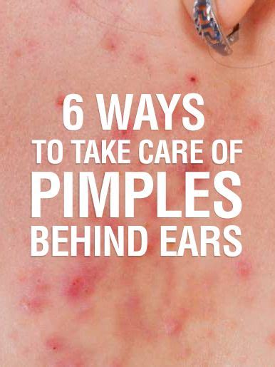 Pimples Behind The Ears 6 Home Remedies And Causes Ear Pimple How