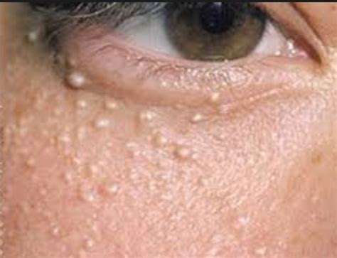 White Spots Under Eyes Little Not Milia Pictures Cholesterol