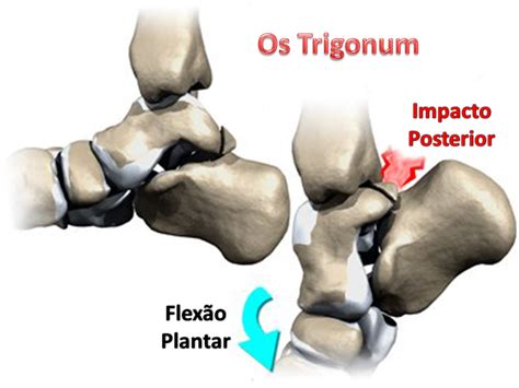 Clínica E Cirurgia Do Pé E Tornozelo Fraturas Do Tálus
