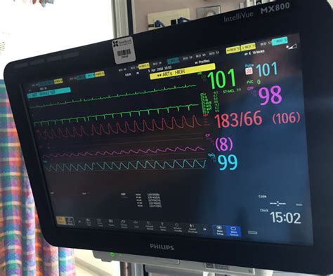 What Do All The Numbers On The Monitor Mean Navigating The Icu