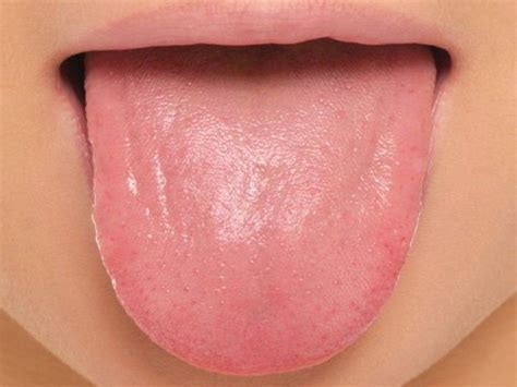 How To Treat Pimples On Tongue Styles At Life