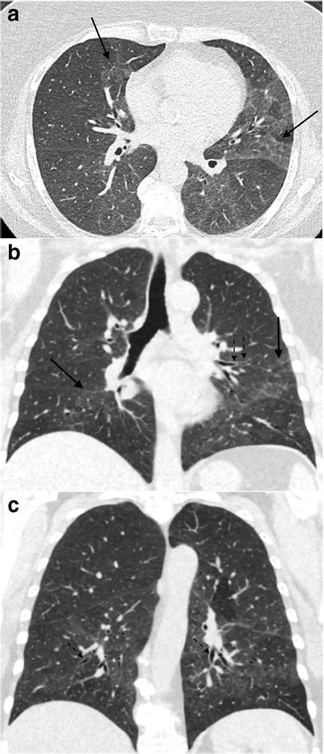 Desquamative Interstitial Pneumonitis Dip A Axial And Bc Coronal
