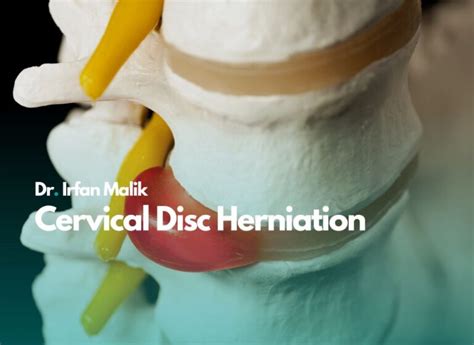 Cervical Disc Herniation Dr Irfan Malik