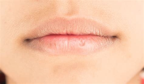 Premium Photo Dry Lips And Peeling