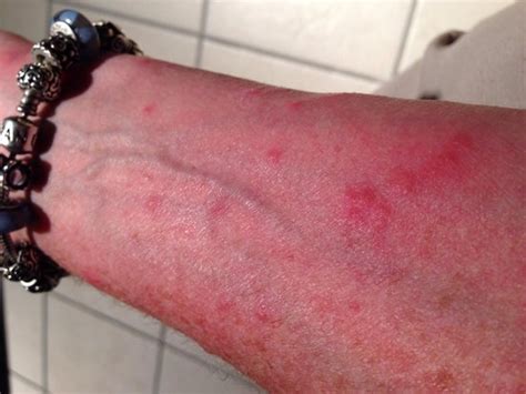 Learn how to minimize and treat bed bug bite scars. Front sign - Picture of Francis Scott Key Family Resort ...