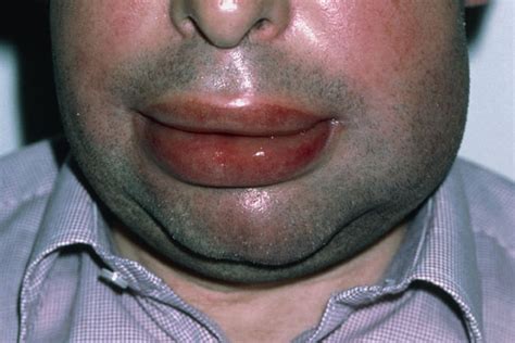 Upper Lip Swelling Food Allergy Sitelip Org