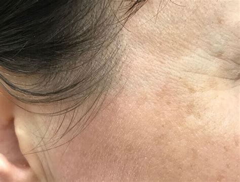 Cryotherapy Skin Tag And Wart Removal In Melbourne