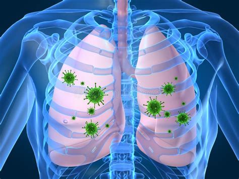 Lung Infection Stock Photo Image 2897020