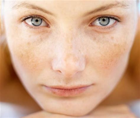 How To Get Rid Of Brown Spots On The Face Smugg Bugg