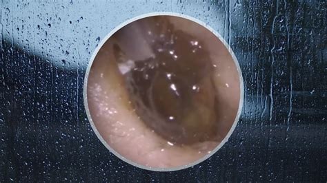 Ear Wax Extending All The Way From The Entrance Towards Eardrum Youtube