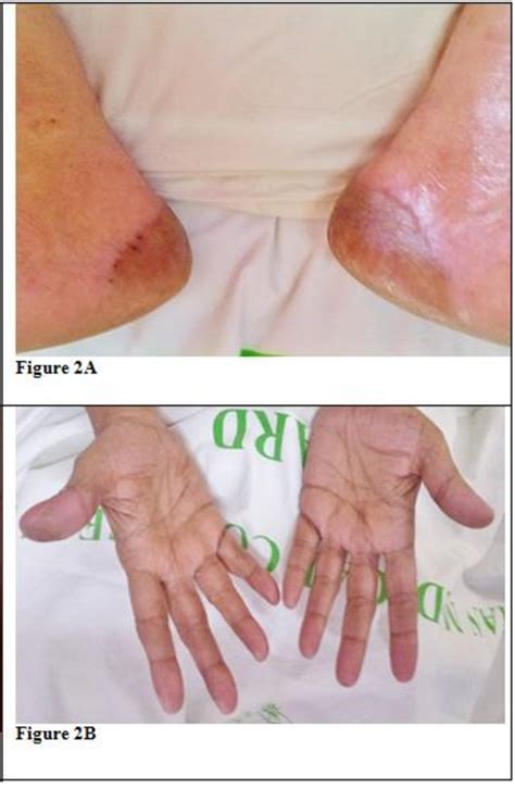 Figure 2 From Sorafenib Induced Hand Foot Skin Rash In Flt3 Itd Mutated