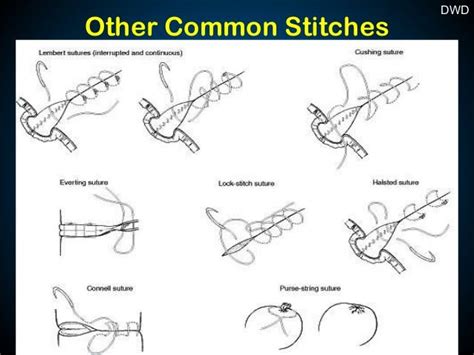 How Many Types Of Stitches In Surgery Patricia Sinclairs Coloring Pages