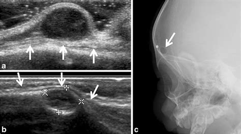 Dermoid And Epidermoid Cysts A Dermoid Cyst In A 1 Month Old Girl Who