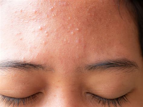 How To Treat Acne Bumps On Your Forehead