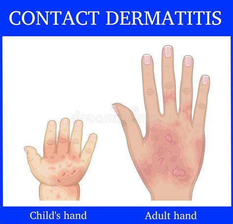 Contact Dermatitis Stock Vector Illustration Of Fever 99305305