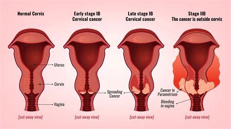Cervical Cancer Stages YourCareEverywhere