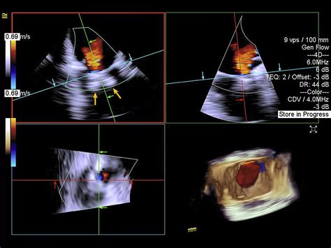 4 Dimensional Intracardiac Echocardiography In Transcatheter Tricuspid