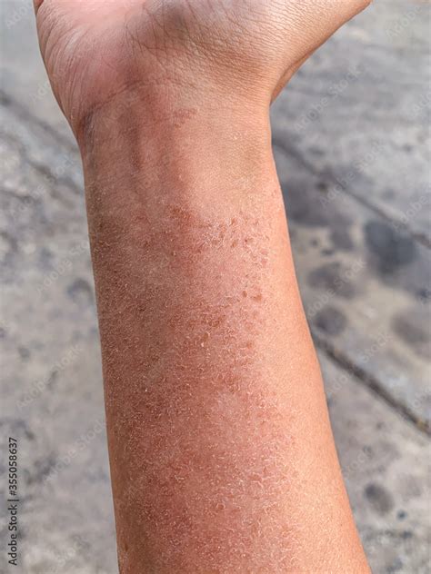 Closeup Dried Rash Of Allergic Contact Dermatitis On Forearm Skin Stock
