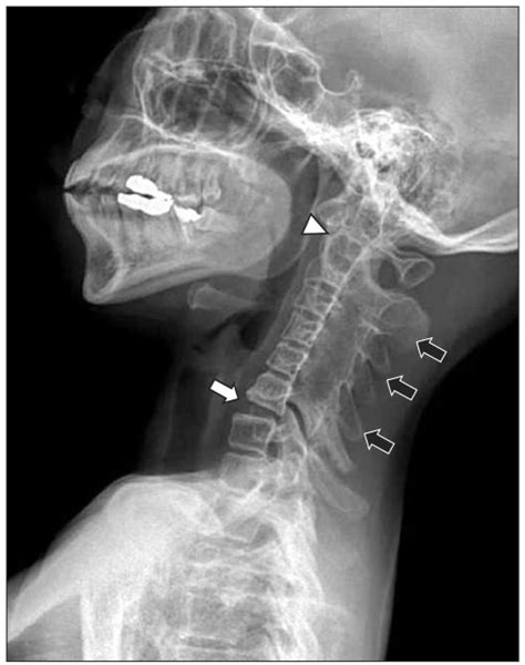 Extension Lateral View Of Cervical Spine X Ray Posterior Facet Fusion