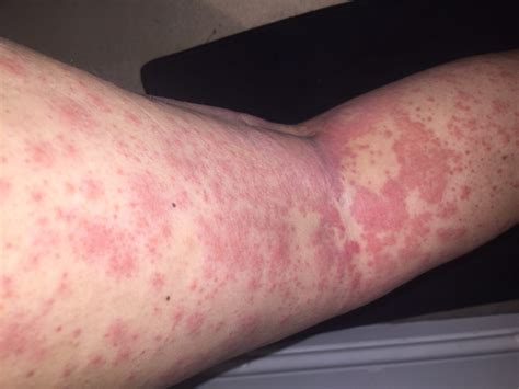 10 Serious Conditions That Rashes And Hives Can Indicate Page 2