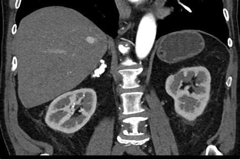 Calcified Adrenal Glands Due To Granulomatous Disease