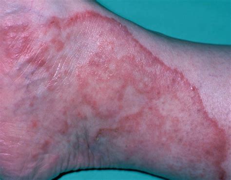 Ringworm Or Athletes Foot A Dermatophyte Infection Caused By A Fungus