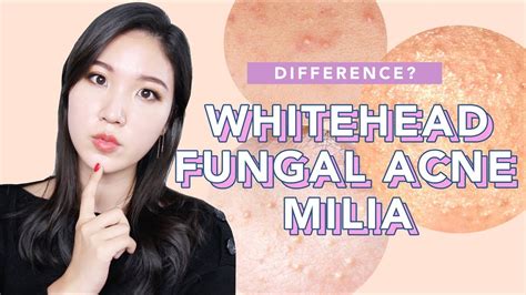 🤔difference Between Whiteheads Milia And Fungal Acne What It Is How