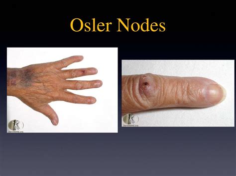 Osler Nodes Dermnet The Website Is Owned By The Derm Museonart