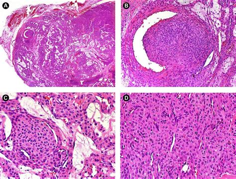 Histopathological Features Of Glomus Tumor A At Low Power