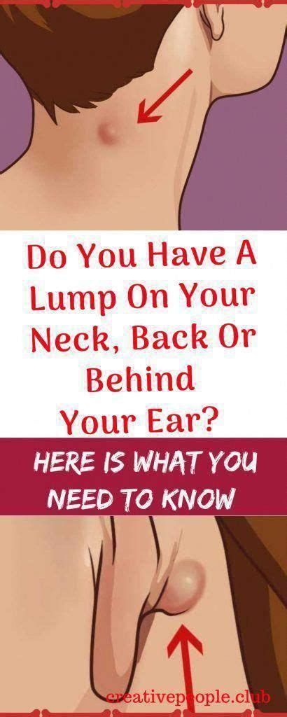 Do You Have Got A Lump On Your Neck Back Or Behind Your Ear This