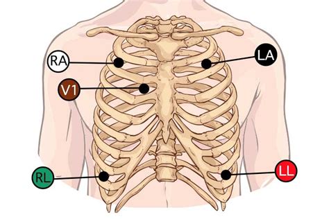 5 Lead Ecg Placement And Cardiac Monitoring Ausmed