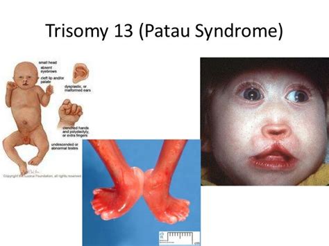 Trisomy 9 Syndrome