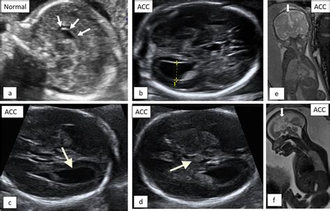 Fetal Ultrasound Scan Of Normal Development Of The Corpus Callosum A