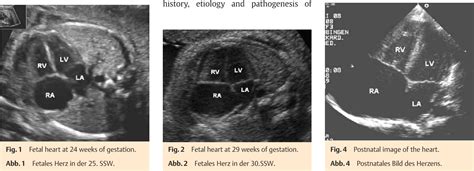 Figure 1 From Fetal Idiopathic Dilatation Of The Right Atrium