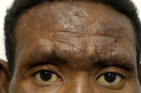 African American Skin Pigmentation