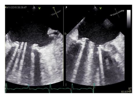 Transesophageal Echocardiography Of The Mitral Valve Prosthesis After
