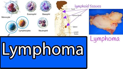 Lymphoma Types Most Common Lymphomas Symptoms And Treatment Youtube