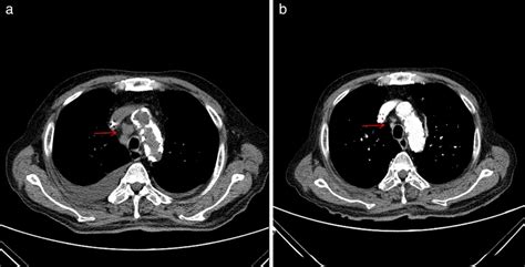 Chest Computed Tomographic Ct Scans A The Chest Ct Scan Showed