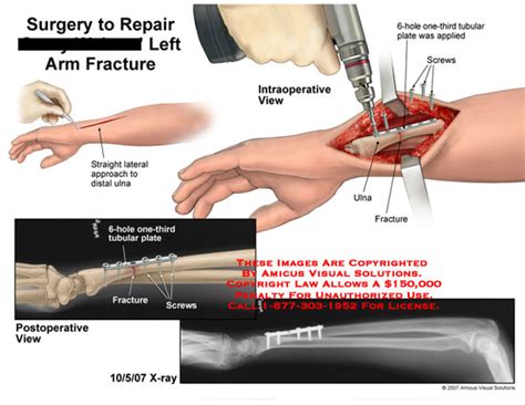 AMICUS Illustration Of Amicus Surgery Arm Fracture Ulna Tubular Plate ORIF Fixation X Ray Xray Wrist