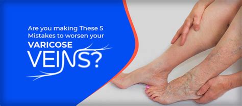 Are You Making These 5 Mistakes To Worsen Your Varicose Veins Karishma