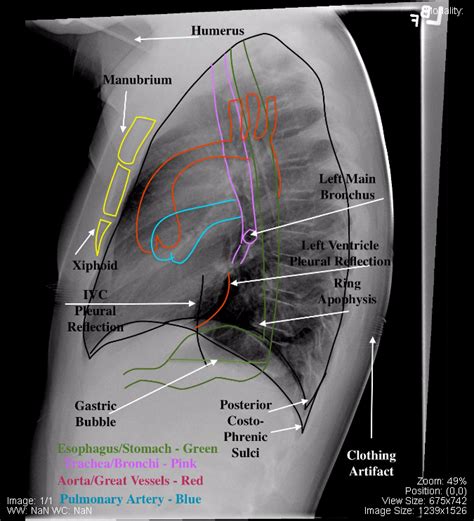Lateral Chest X Ray Labeled