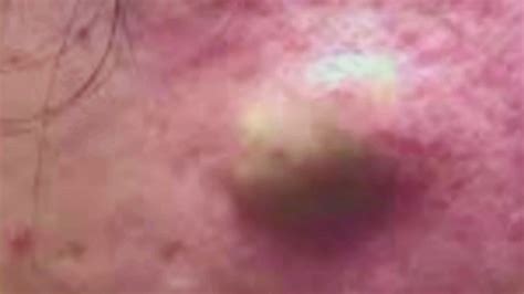 Pimples Popping On Nose Blackheads Removal Cystic Acne Extraction