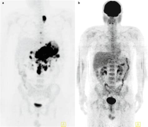 Lymphoma Radiology Key