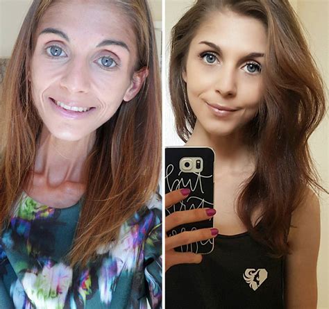 10 Fotos Antes Y Después De Personas Que Derrotaron A La Anorexia