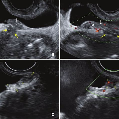 Residual Endometriosis Of The Bladder Wall After Bladder Resection For Download Scientific