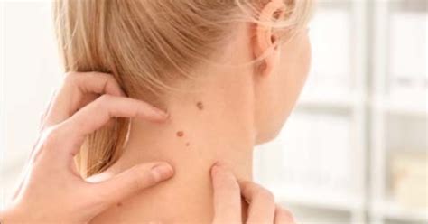 Skin Cancer Recurrence The Essential Warning Signs You Should Be Aware