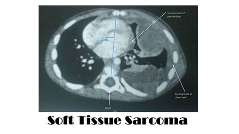 Soft Tissue Sarcoma 7 Types Causes Symptoms And Diagnosis