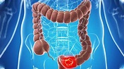 What You Need to Know About The Stages of Colon Cancer ...