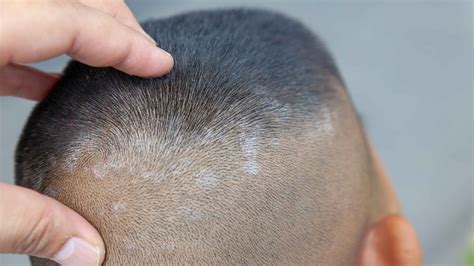 Difference Between Psoriasis and Dandruff | Man Matters
