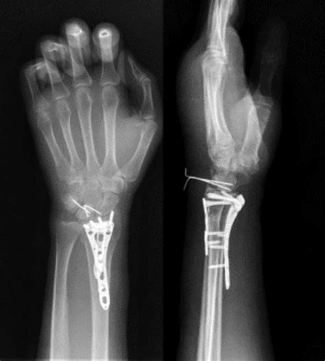 Hand Wrist Fractures Reduction Internal Fixation Fracture Distal My